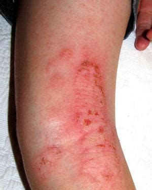 Impetigo rash facts | General center | SteadyHealth.com