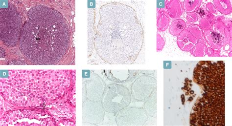 Lobular carcinoma in situ, florid type. (A): the acinar units are ...