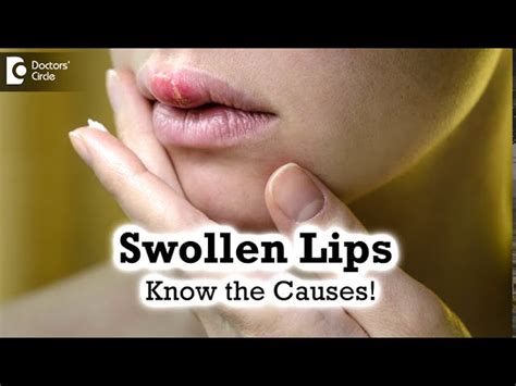 Swollen Lips And Hives Pictures | Lipstutorial.org