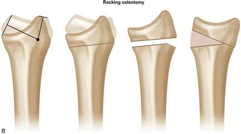 80: Corrective Osteotomy of Malunited Distal Radius Fractures | Plastic Surgery Key