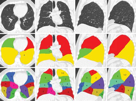 Figure 2 from Automatic Segmentation of Pulmonary Segments From ...