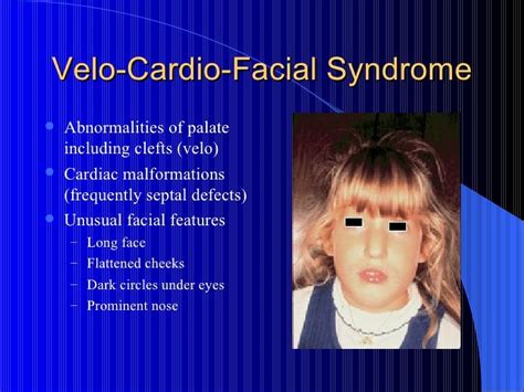 Pin by nonas arc on Goldberg-Shprintzen Syndrome (aka Velocardiofacial ...