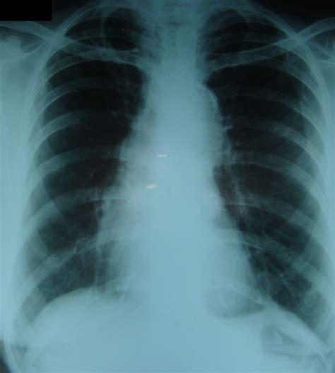 Intimal calcification in aortic knuckle – X-ray chest PA – All About ...