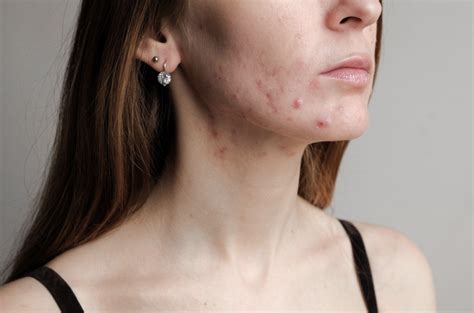 How do you know if your acne is hormonal? • Illuminate Skin Clinics