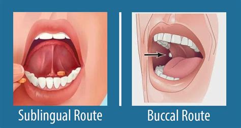 Buccal and Sublingual Routes of Drug Administration: Advantages and ...