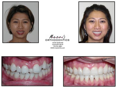 Open Bite Jaw Surgery & Braces Before and After Treatment