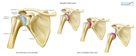 Shoulder Dislocation | Rehab My Patient