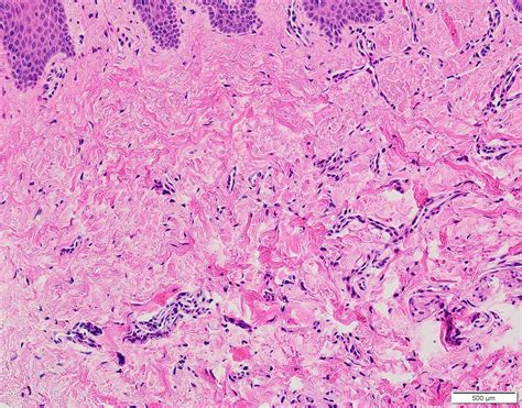 Pathology Outlines - Irritation fibroma