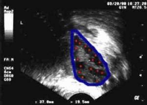 Antral Follicle Counts, Testing Ovarian Reserve Predicts IVF Response