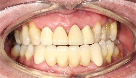 4 Upper Anterior Crowns and 6 units Lower Anterior Bridge | Dental Blog - Bounty Road Dental ...