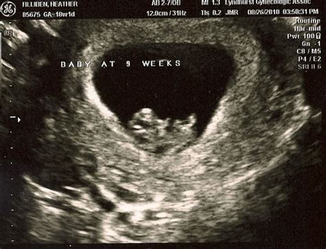 two lil fillibens: First Ultrasound - 9 Weeks