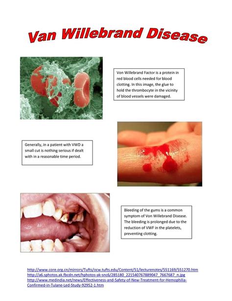 Von Willebrand Disease: Poster | Von willebrand disease, Von willebrand factor, Kids health