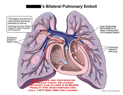 AMICUS Illustration of amicus,injury,lung,pulmonary,emboli,clot,blood,embolism,oxygen,circulation