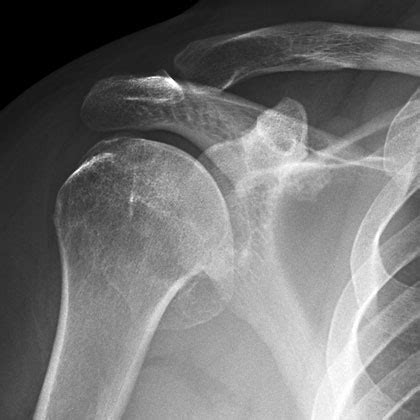 Shoulder Arthritis Images | Dr. Paul Grutter, MD