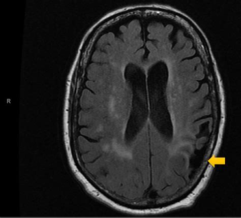 Cureus | Chronic Post-stroke Psychosis with Left Cortical and Bilateral Inferior Cerebellar ...