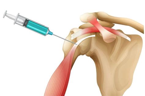 Steroids vs Prolotherapy: Intra-Articular Steroid Injection