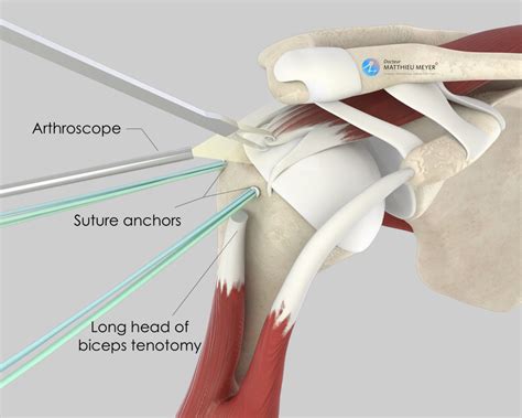 Rotator Cuff Repair