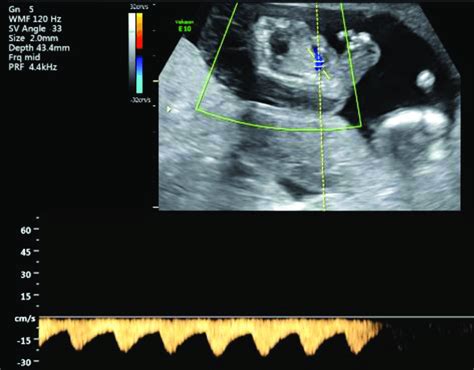 Image of the acardiac twin with reverse flow from the pump twin ...