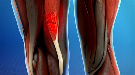 Lesiones en el bíceps femoral - Clínica Martín Gómez Traumatólogos