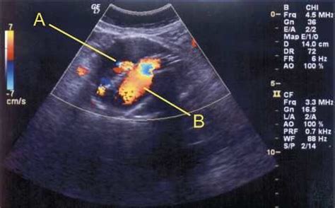 (A) Large type I endoleak viewed with ultrasound longitudinal axis. (B ...