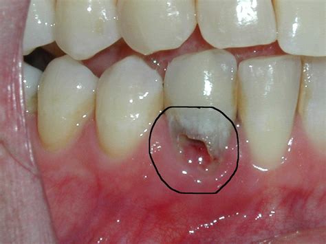 External Resorption Of Tooth