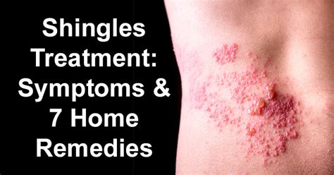 Shingles Treatment: Symptoms & 7 Home Remedies For Shingles - David Avocado Wolfe