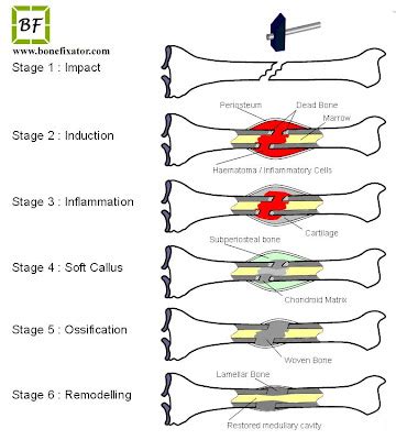 Essential Questions: How Would Your Body Respond If You Broke A Bone