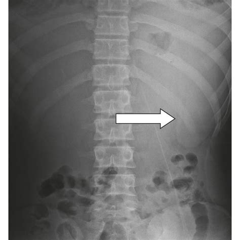 Sentinel loop sign and colon cut-off sign in a similar plain abdominal ...