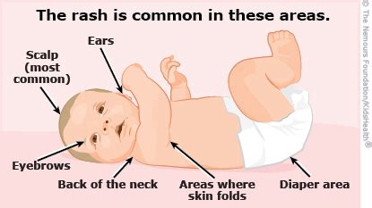 Cradle Cap (Seborrheic Dermatitis) in Infants | Rady Children's Hospital