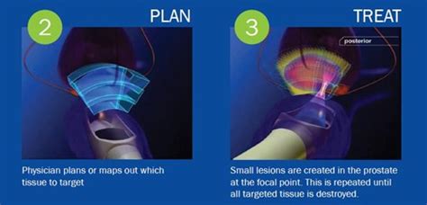 HIFU (High Intensity Focused Ultrasound) | United Urology