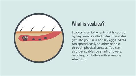 Scabies: Signs, Symptoms, Causes, and Treatment | Merck Manual Consumer Version - YouTube