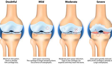 Everything You Need to Know About How Knee Arthritis is Classified and Treated | Mahwah Valley ...