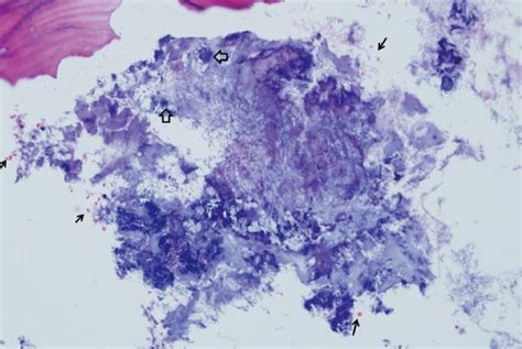 Gram positive colonies of actinomyces (sun-ray pattern, open arrow) and ...