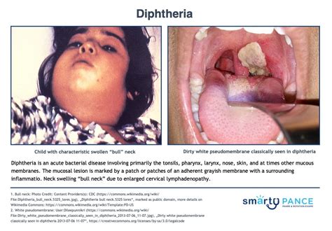 Diphtheria Bull Neck