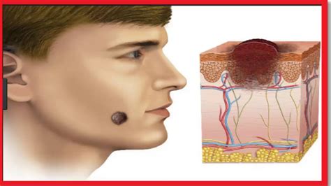 Sintomas Del Cancer De Piel