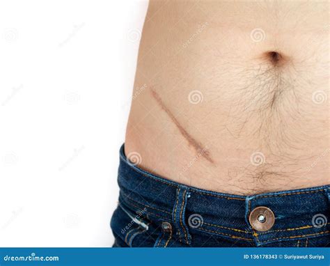 Normal Appendicitis Scar