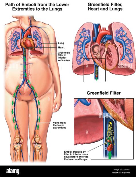 Pulmonary embolism hi-res stock photography and images - Alamy