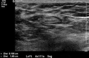 Normal lymph node: On ultrasound, lymph nodes typically are smooth,... | Download Scientific Diagram