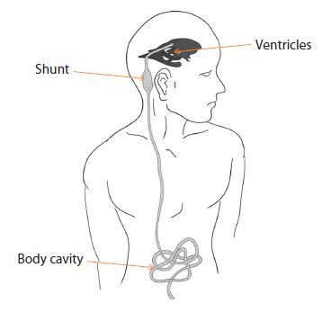 Adult Hydrocephalus - Conditions & Treatments | SingHealth