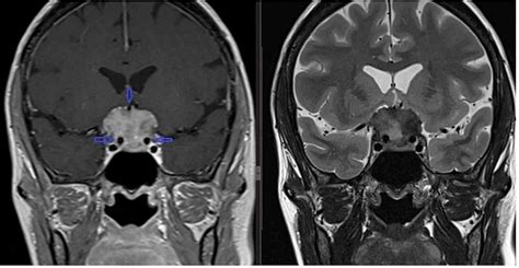 Suprasellar Meningiomas: An Experience of Four Cases With Brief Review ...