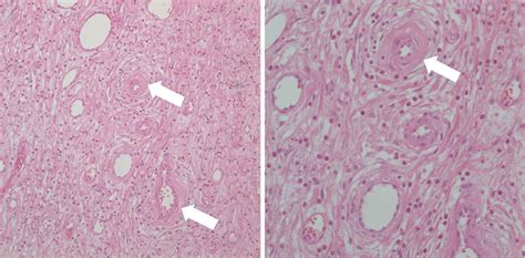 (A, B) Histology was compatible with inflammatory fibroid polyp... | Download Scientific Diagram