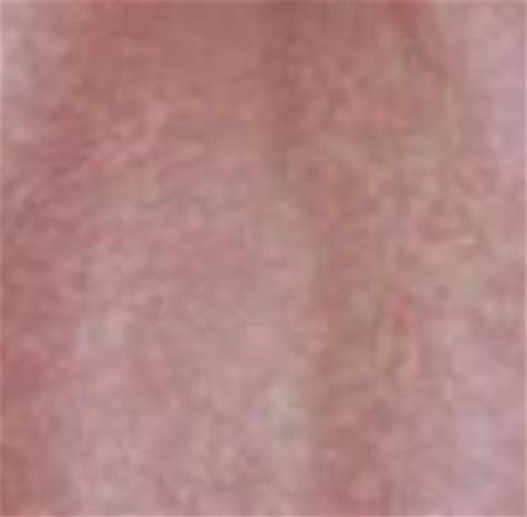 Lamictal Rash - Pictures, Symptoms, Treatment | Health Momma