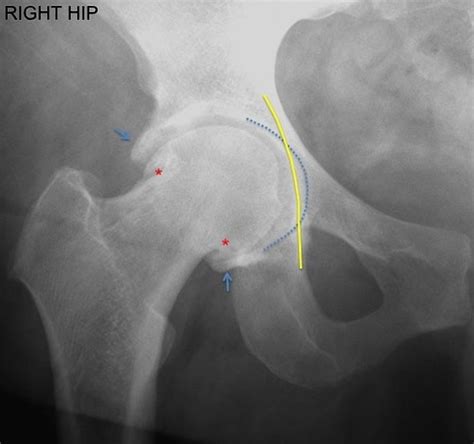 Pincer type femoroacetabular impingement | Radiology Case | Radiopaedia.org | Impingement ...