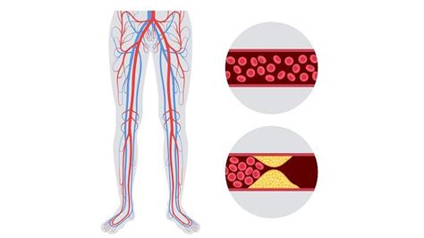 Fracture Complications | DePuy Synthes