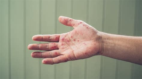 Atopic Dermatitis Palms