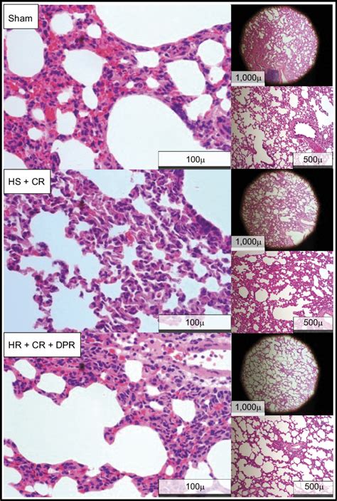 Lung histopathology slides. Lung histopathology is shown in the ...