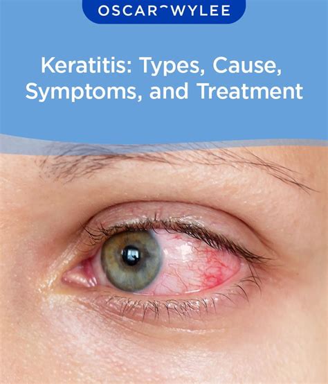 Keratitis: Types, Cause, Symptoms, and Treatment