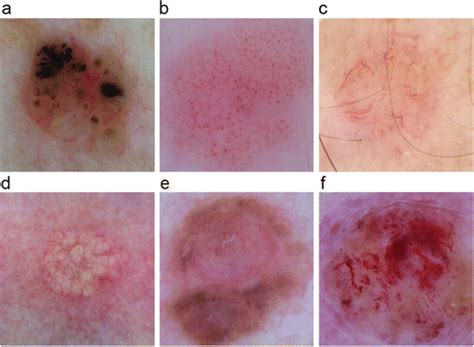 Examples of vascular structures seen in dermoscopic images of skin... | Download Scientific Diagram