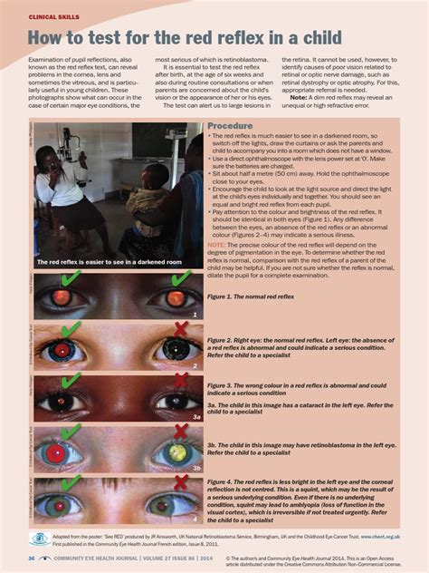 How To Test For The Red Reflex in A Child | PDF | Eye | Retina