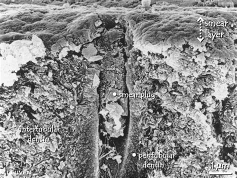 Bonding to Dentin: Smear Layer and the Process of Hybridization ...